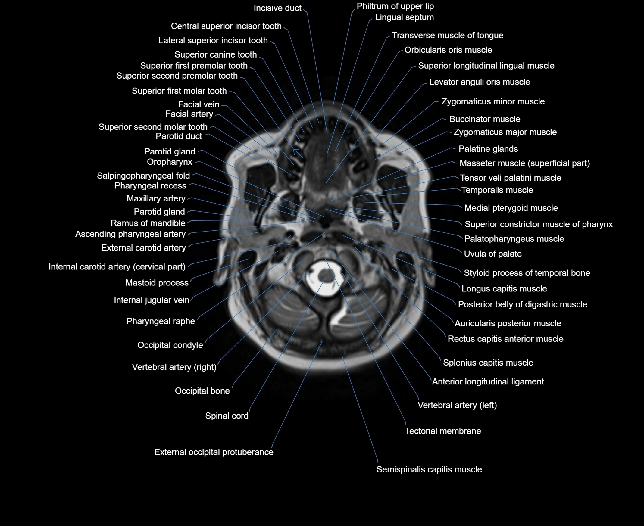 MRI Neck 3D labelled cross section anatomy axial 3t image-00001-00022.webp